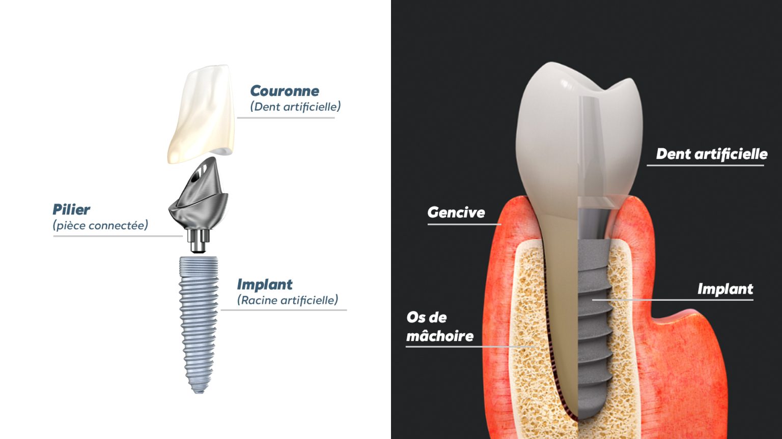 Dentier Fixe Tout Savoir Sur Ce Type De Dispositif