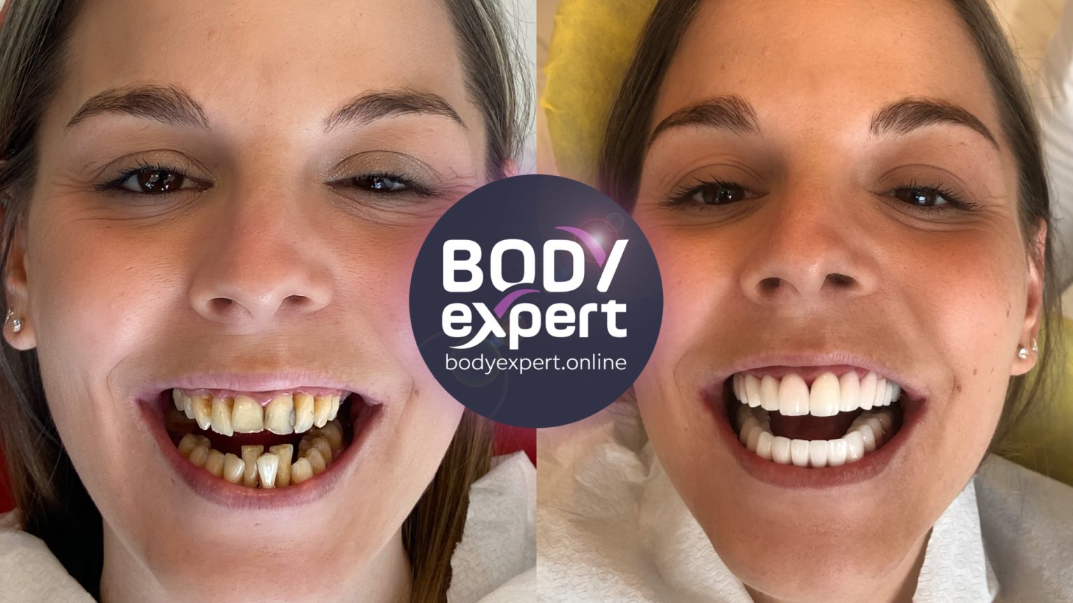 Dental Implants Before After Results After Placement Body Expert