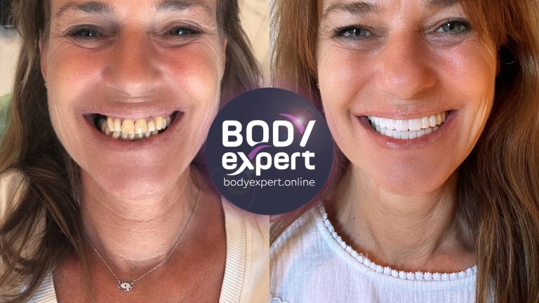 Refaire Ses Dents Les Solutions Possibles Et Leurs Prix Body Expert