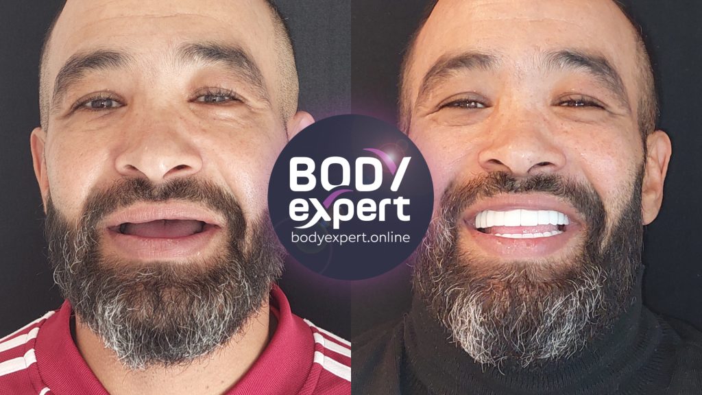 Refaire Ses Dents Les Solutions Possibles Et Leurs Prix Body Expert