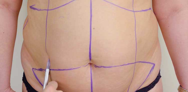 Chirurgie esthétique : comment obtenir des abdominaux parfaits ?