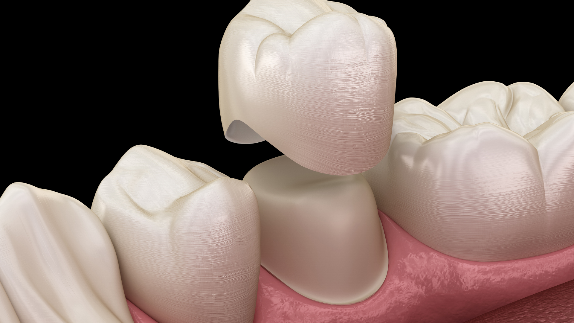 Couronne temporaire Résine ultra mince Blanchiment des dents Facettes  dentaires antérieures Prothèse dentaire Ombre dentaire Souriant