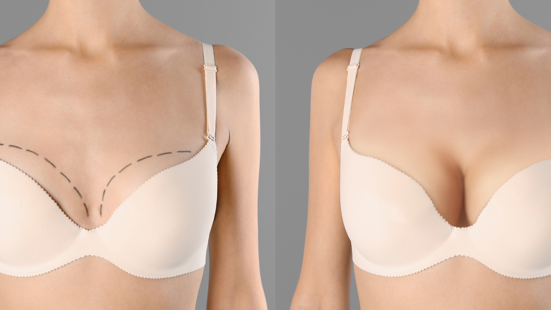Premium Photo  Female breast comparison before and after breast asymmetry  correction surgery