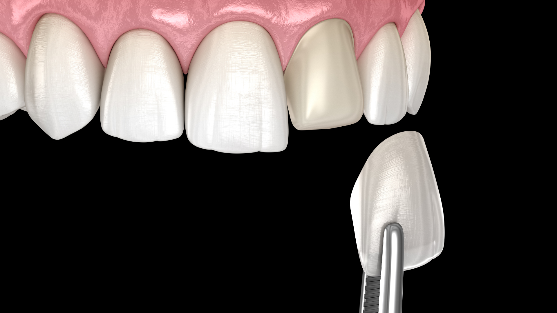 The Benefits Of Composite Veneers - shesafitchick