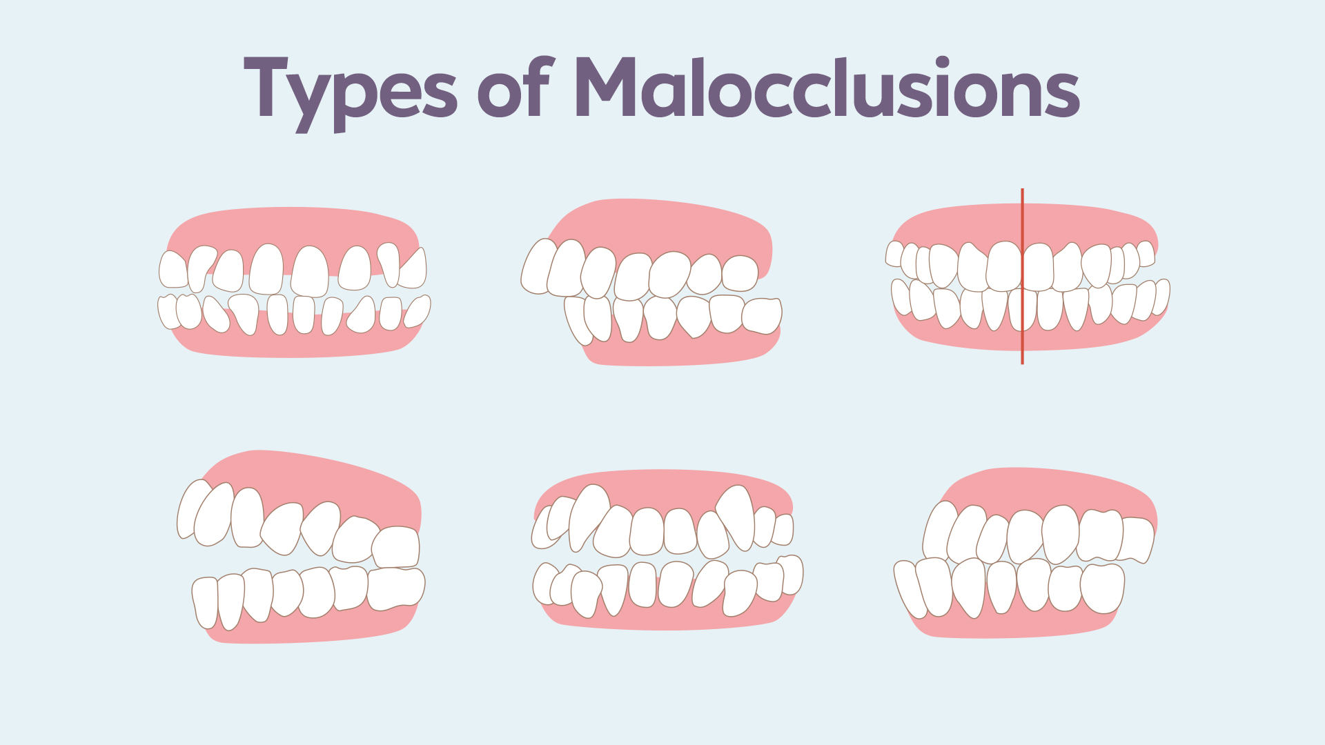 Types Of Malocclusion