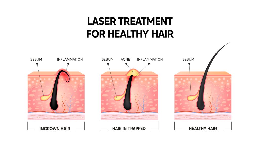 Laser hair growth treatment: everything you need to know about it