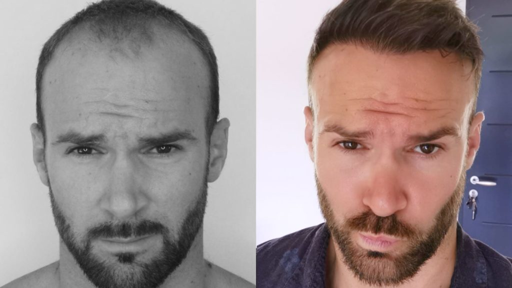 Hair Transplant 3 Months Post Surgery Results Before and After Hair  Transplant