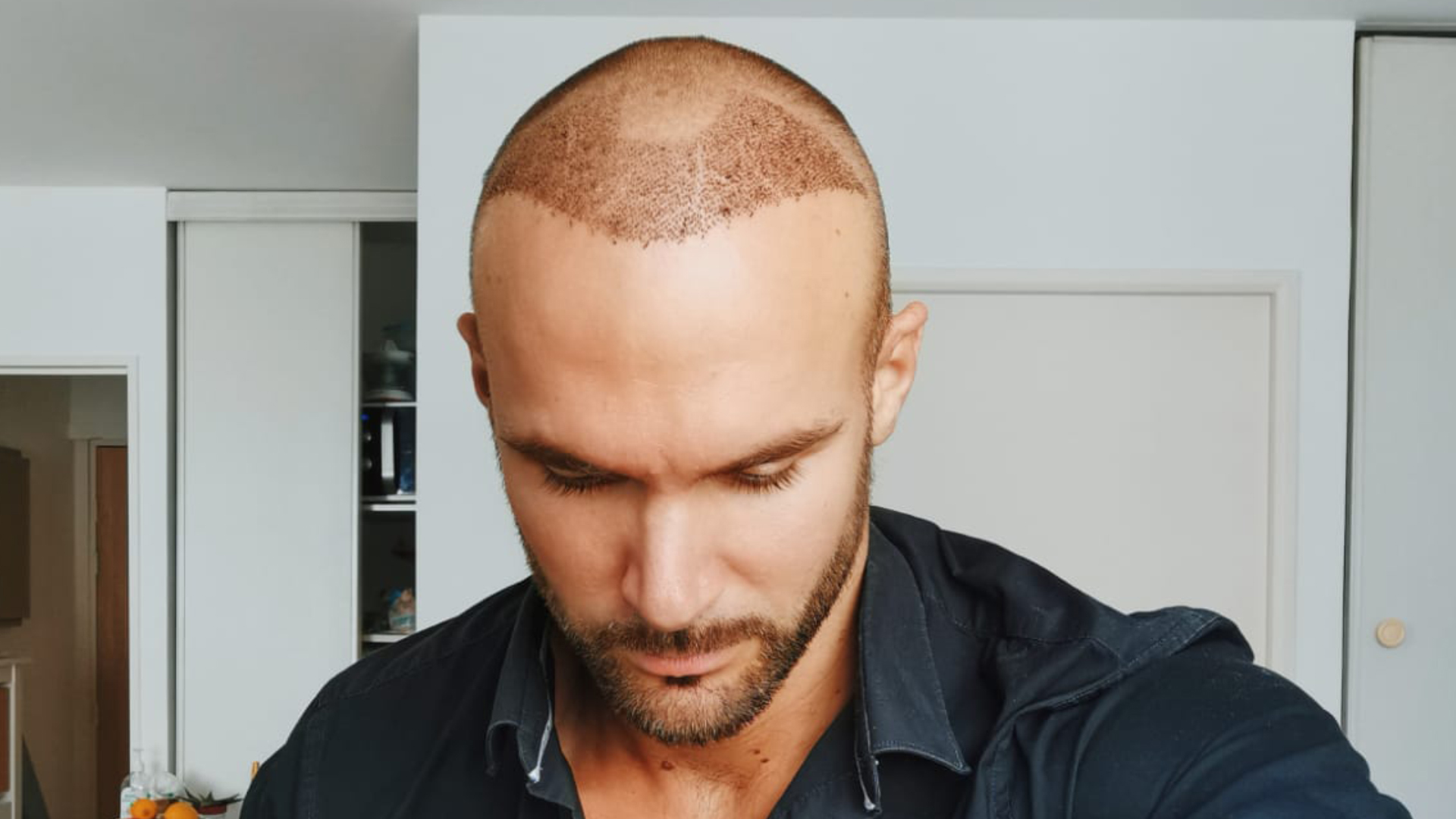 When is the Best Time for Hair Transplant