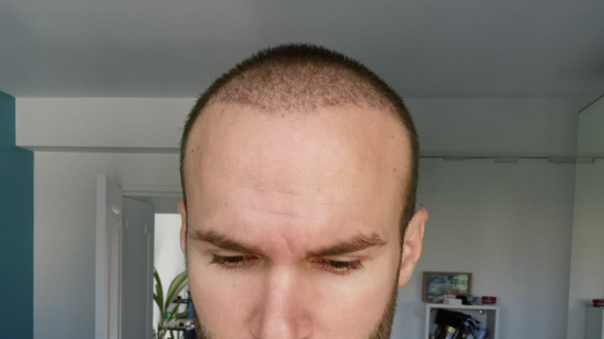 My Three Months Hair Condition After FUE Hair Transplant  NBCRUISER