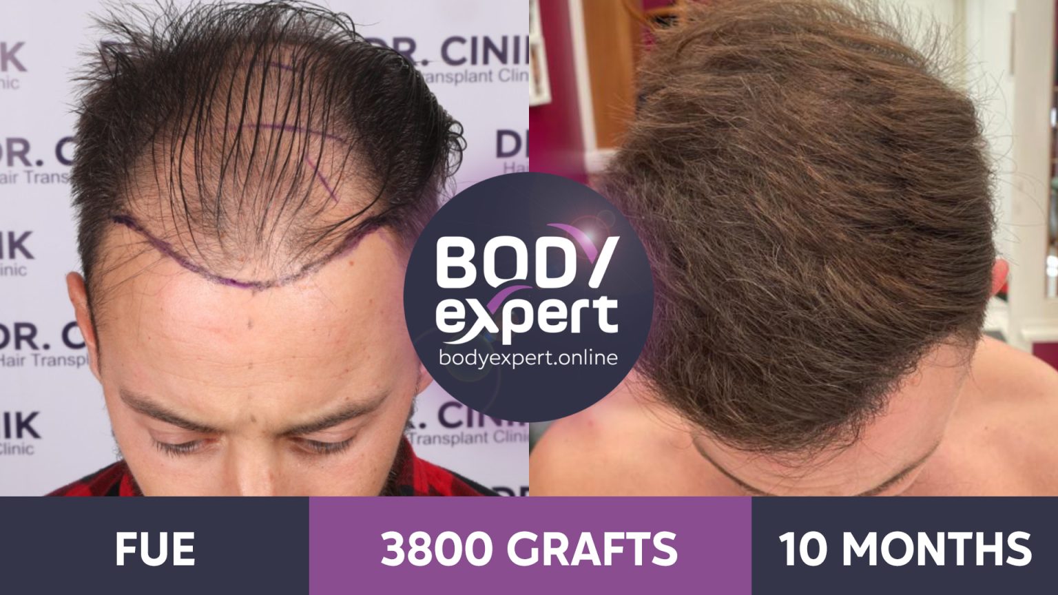 Hair Transplant Before And After Photos Body Expert 5788