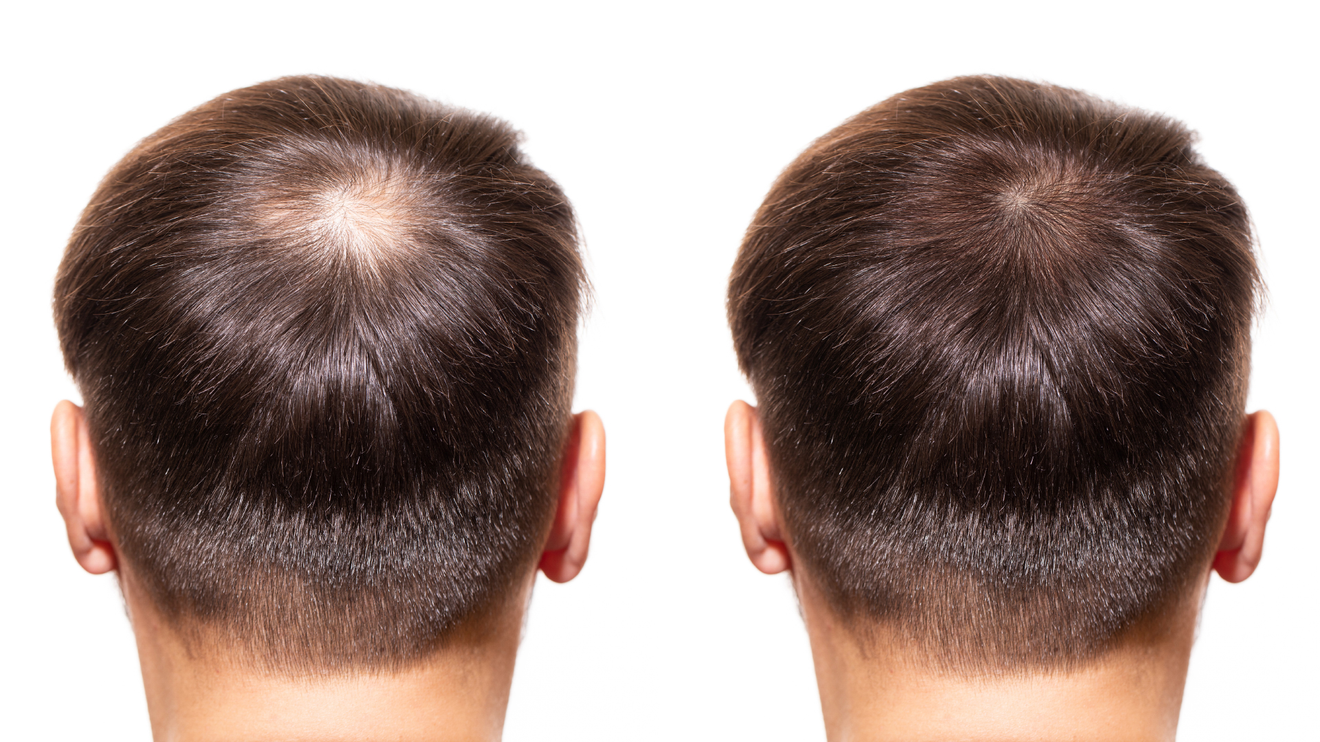 a man with baldness on the top of the skull having undergone a hair transplant, androgenetic alopecia being irreversible it is possible that he will have to perform a second hair transplant