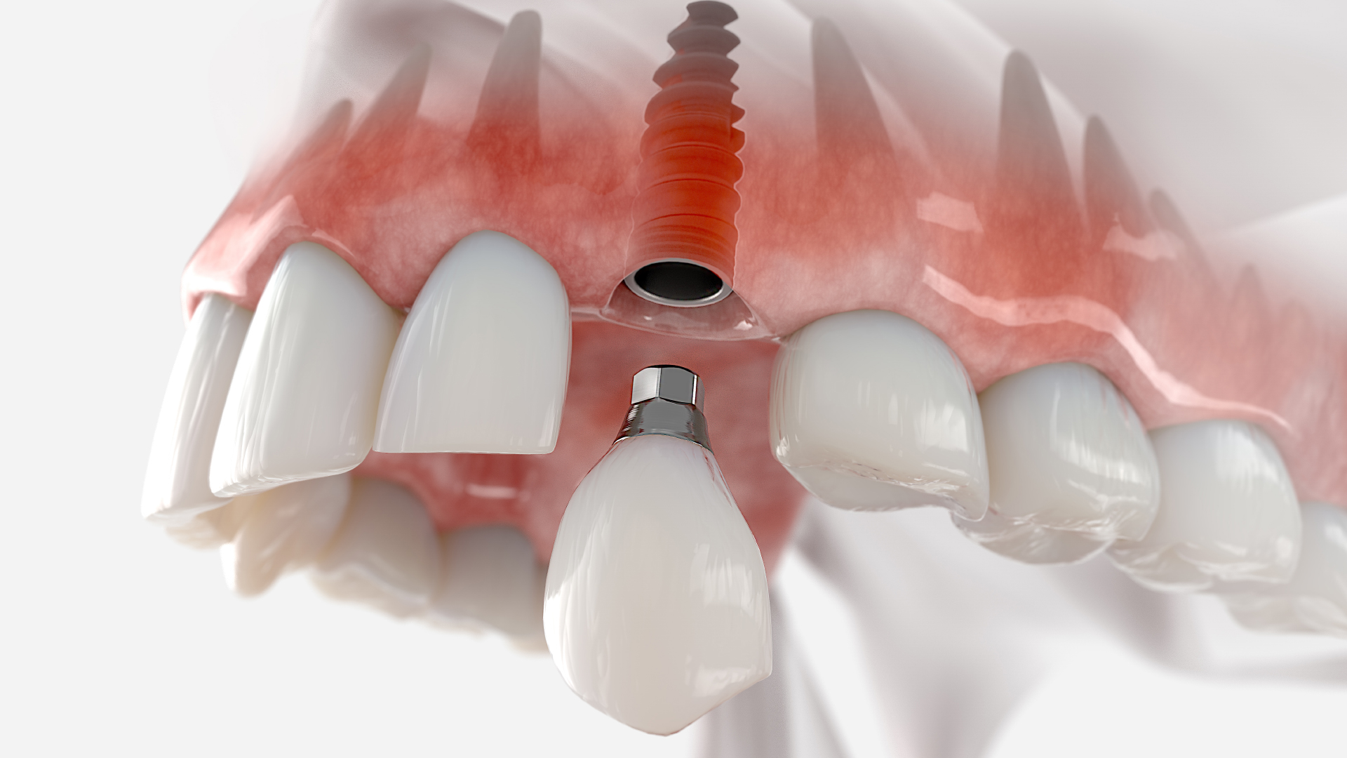 Prothèse dentaire fixe : tout savoir sur ses dispositifs