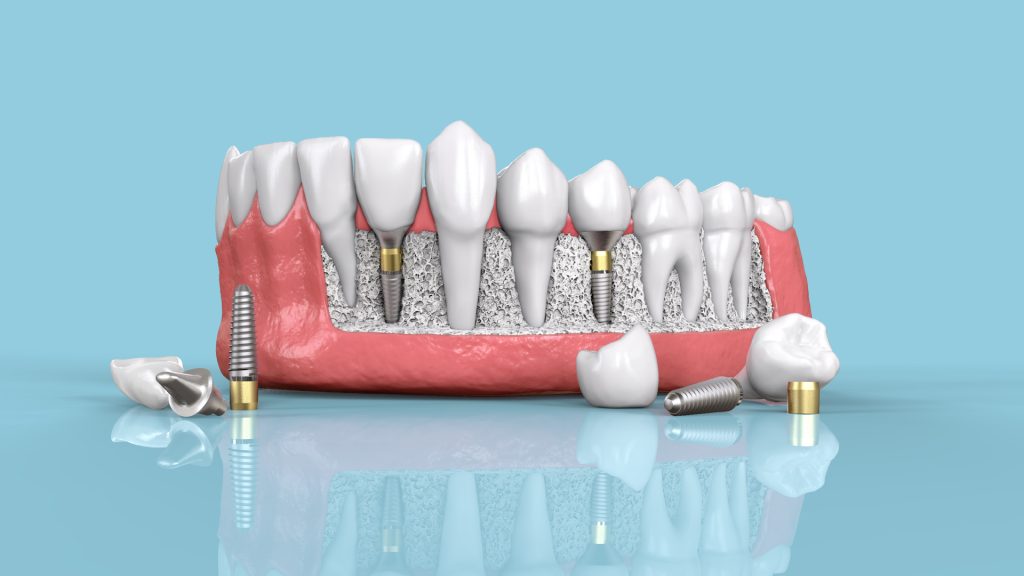 Mini-implant dentaire à vis - Tous les fabricants de matériel médical