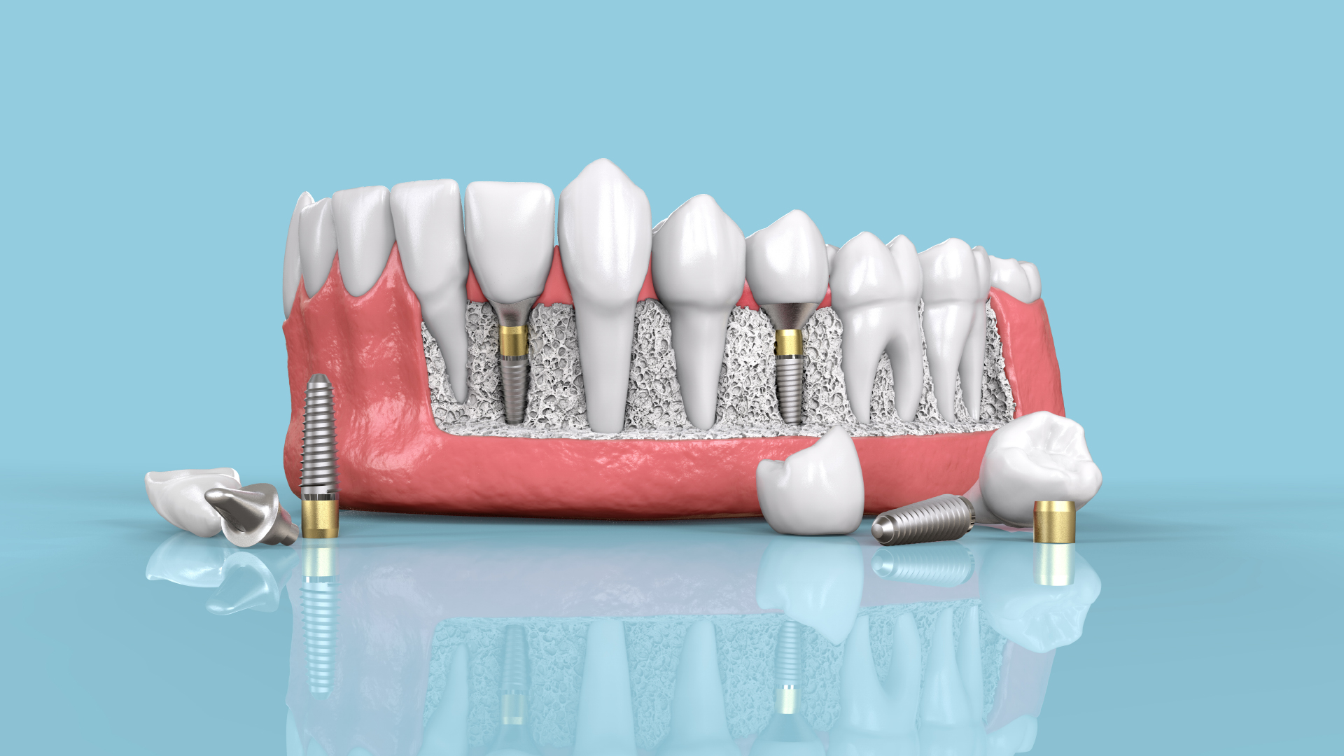 Dent cassée (fracturée). Quelles peuvent être les causes des dents cassées?  Que faire dans l'immédiat? Combien ça coûte?