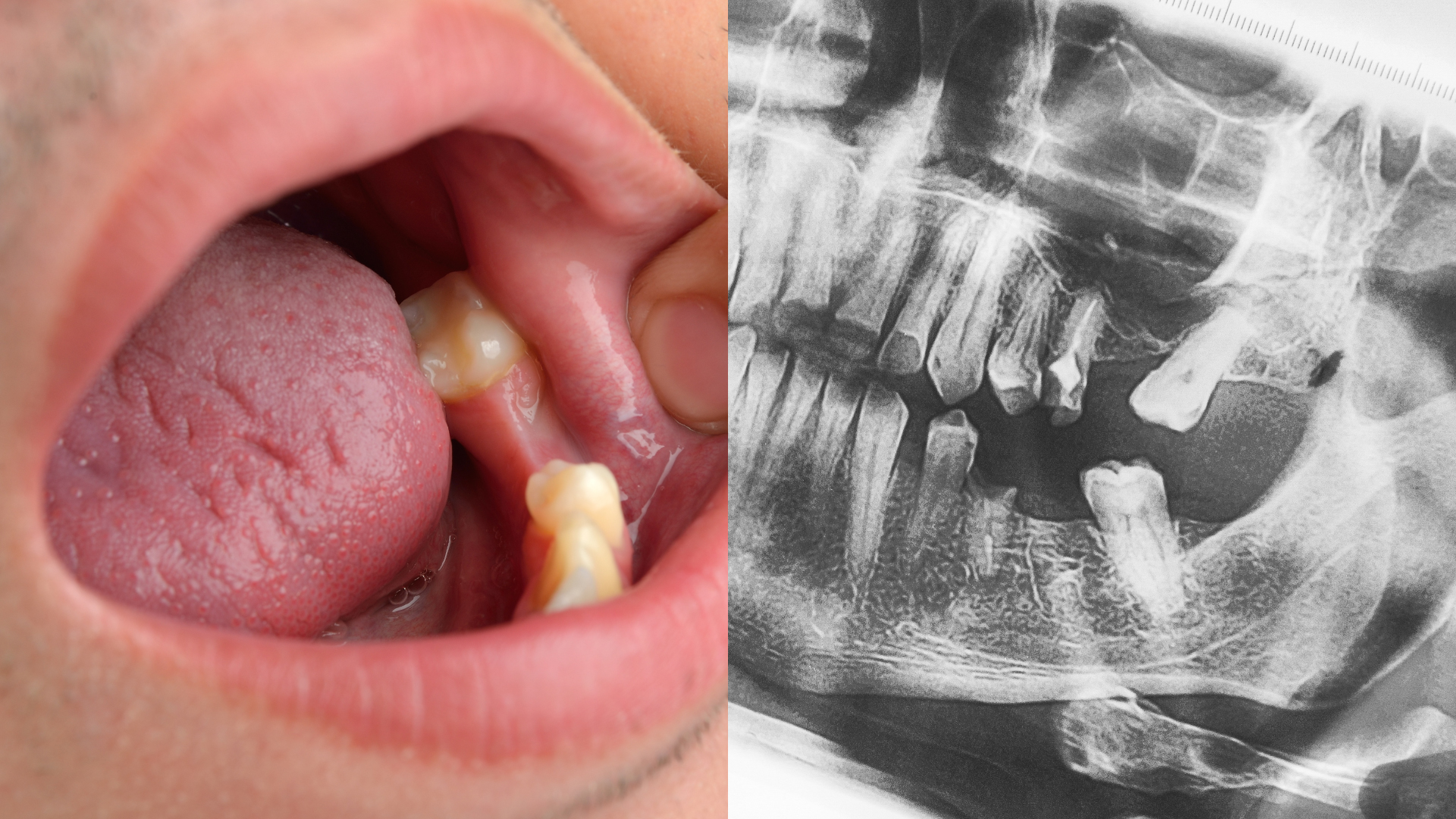 Ciment Dentaire  Colle Dentaire Pour Couronne Bridge Dent sur