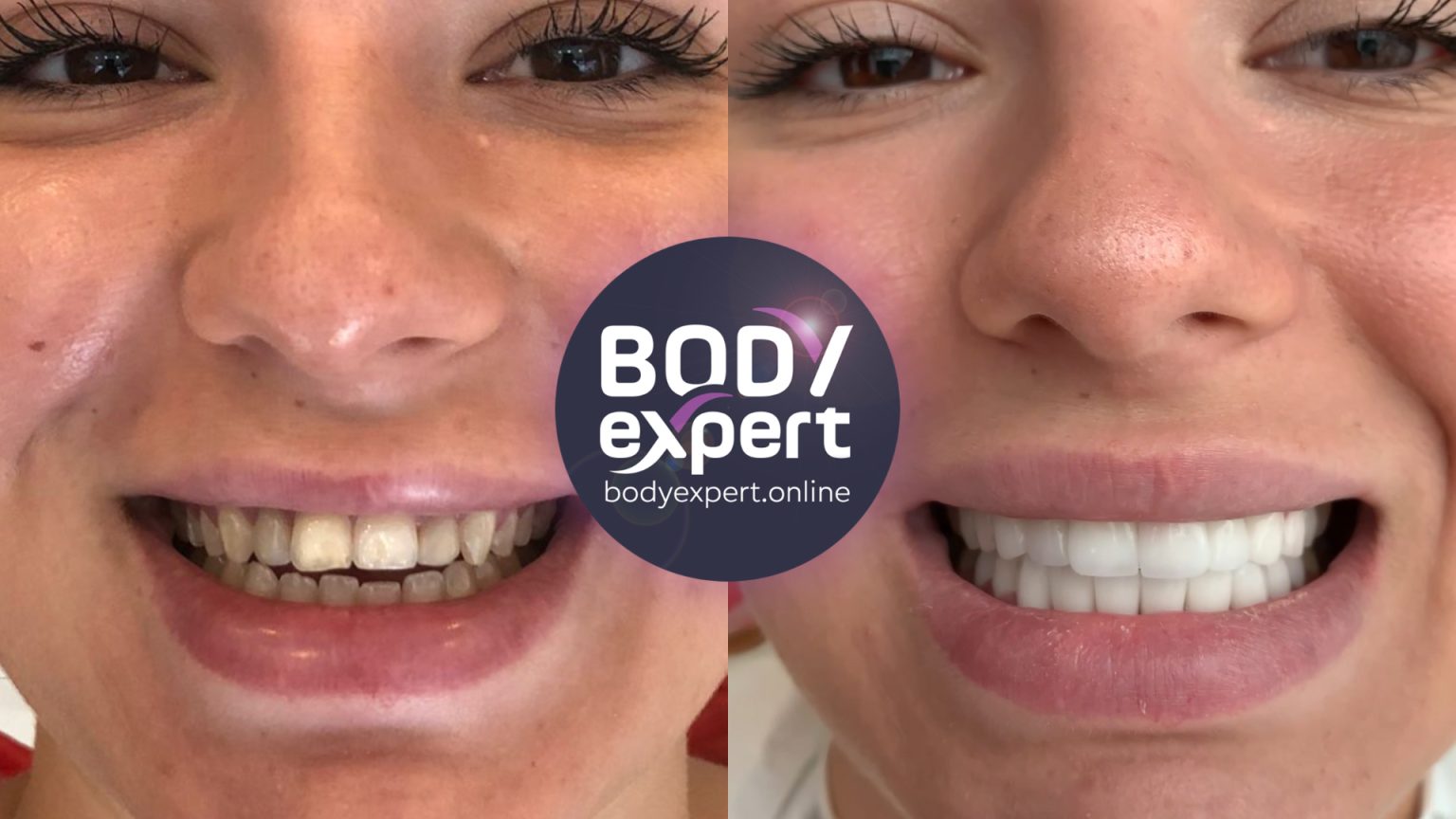 Dental crowns before and after : see our patients’ results | Body Expert