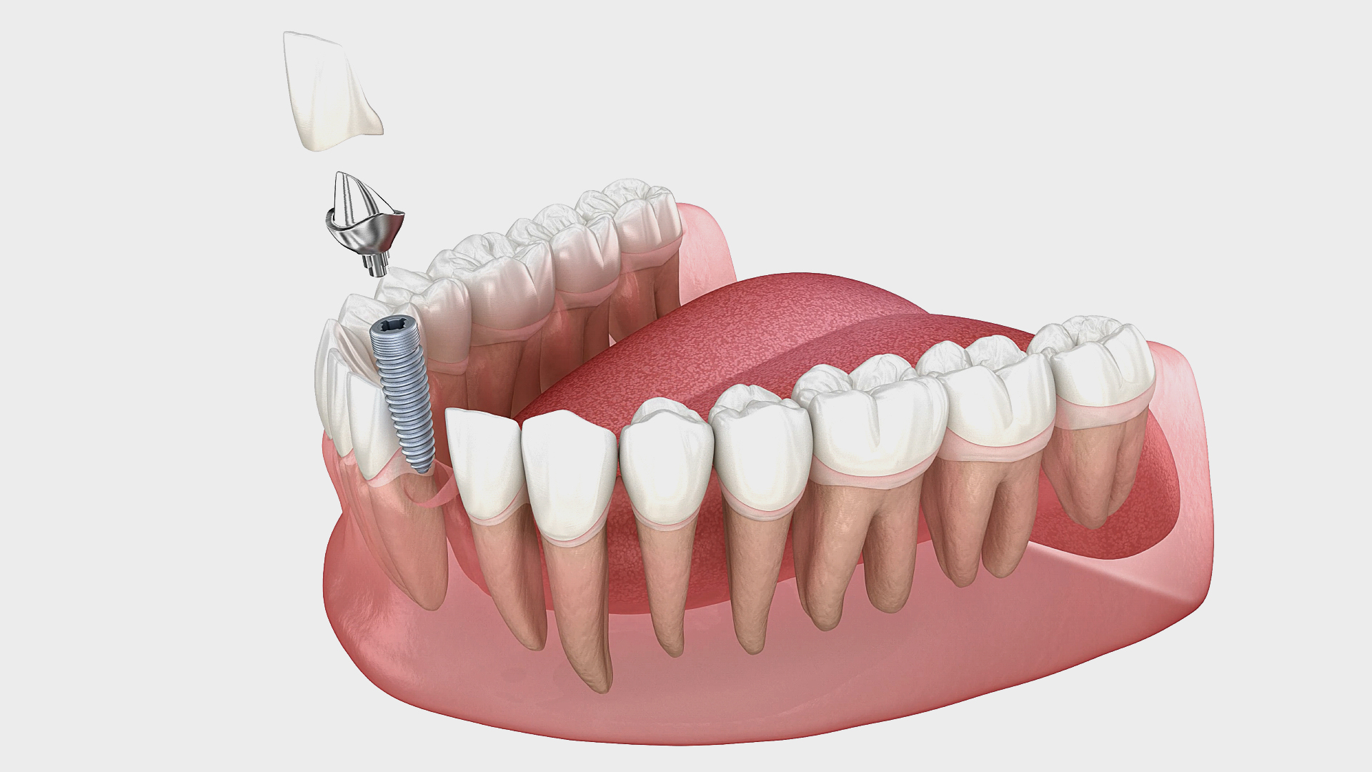Mini-implant dentaire à vis - Tous les fabricants de matériel médical