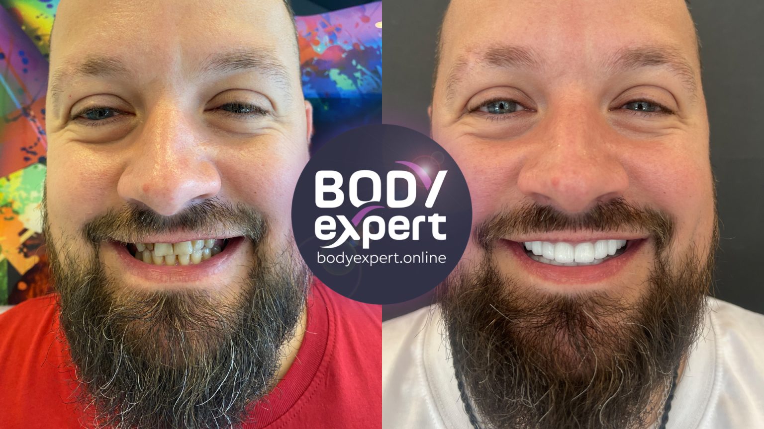 Dental implants: before - after, results after placement | Body Expert