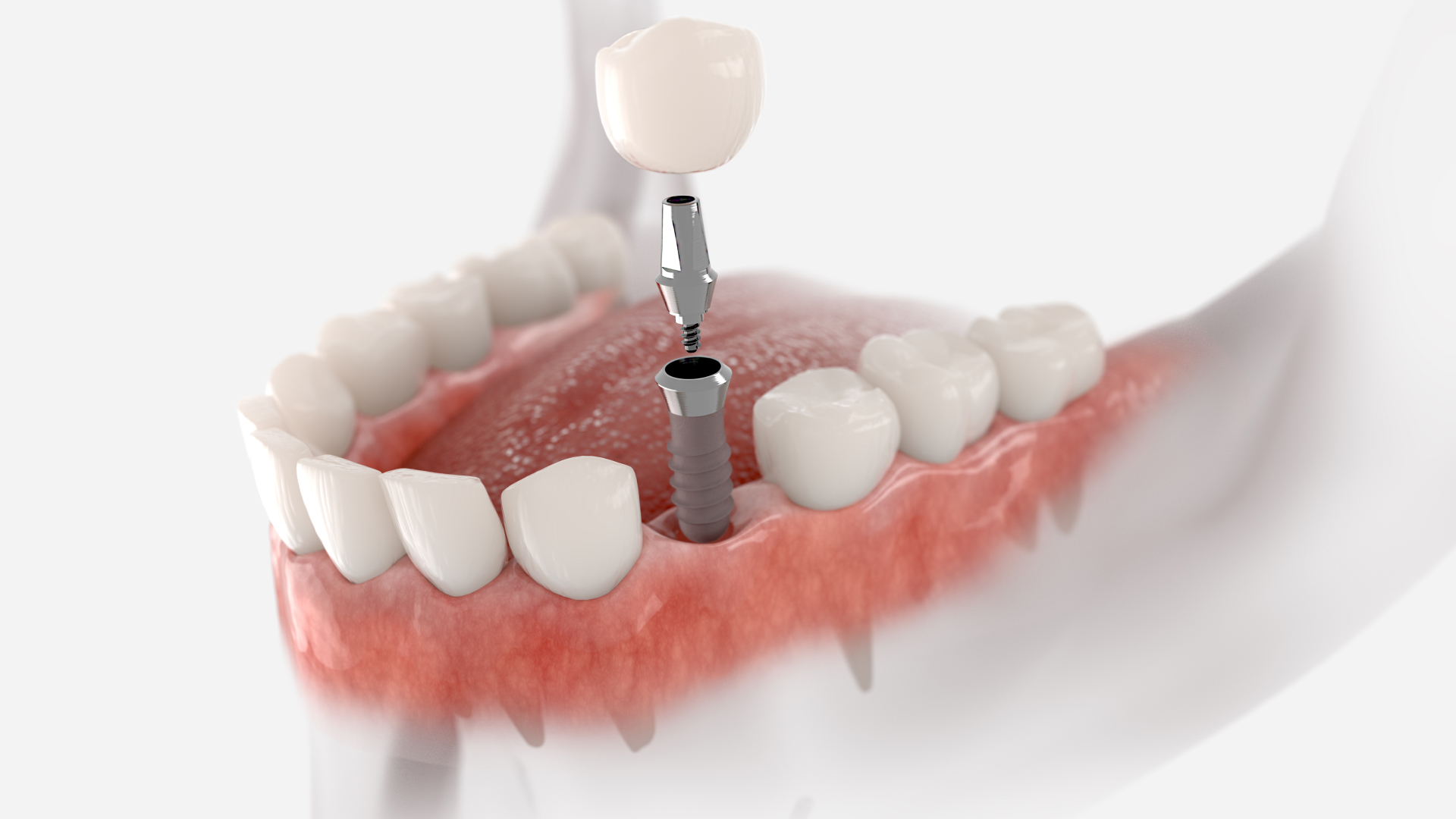 Dents pour appareil dentaire ou dentier, dent esthétique durable - Tout  Dentaire
