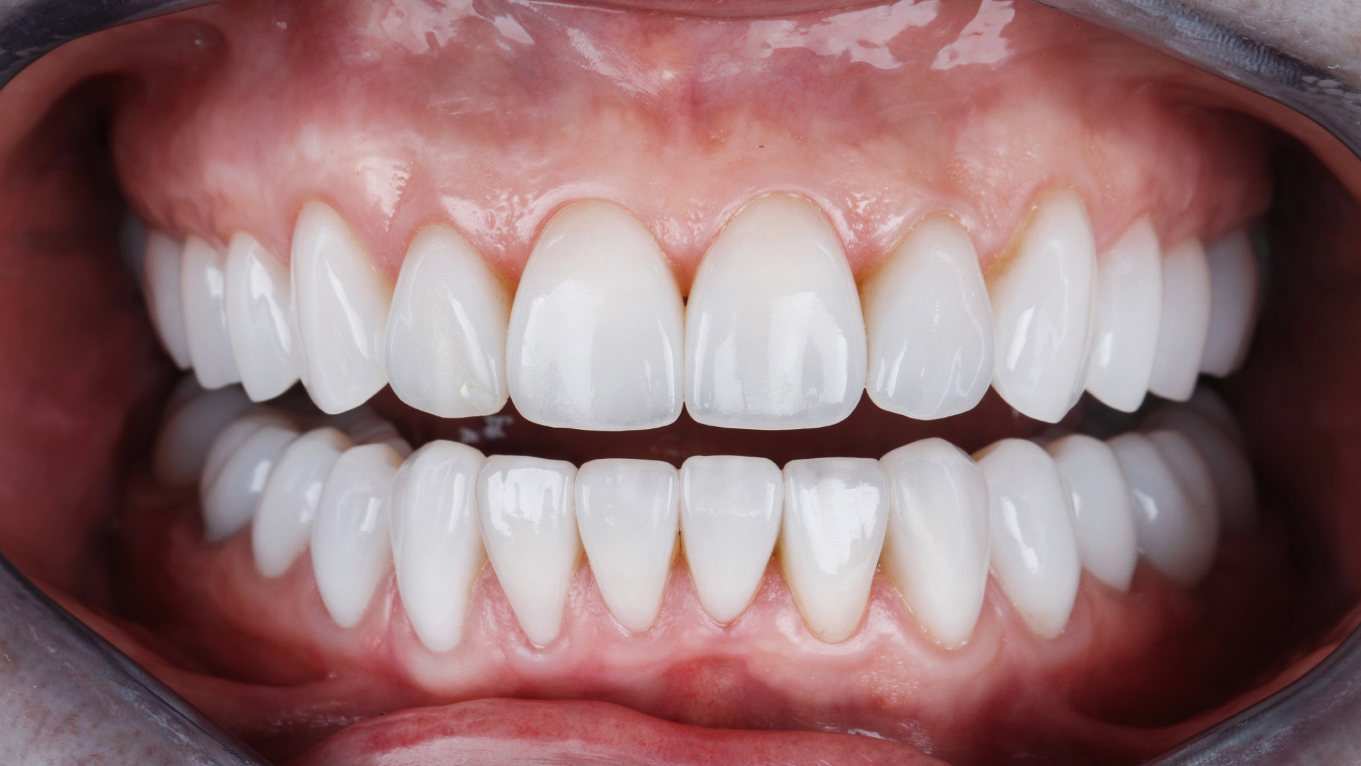 Limer les dents : Tout savoir sur le remodelage dentaire - Centre Dr