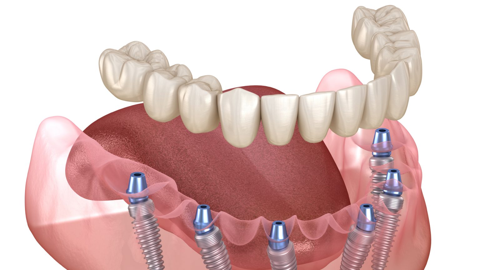 Refaire Ses Dents Les Solutions Possibles Et Leurs Prix