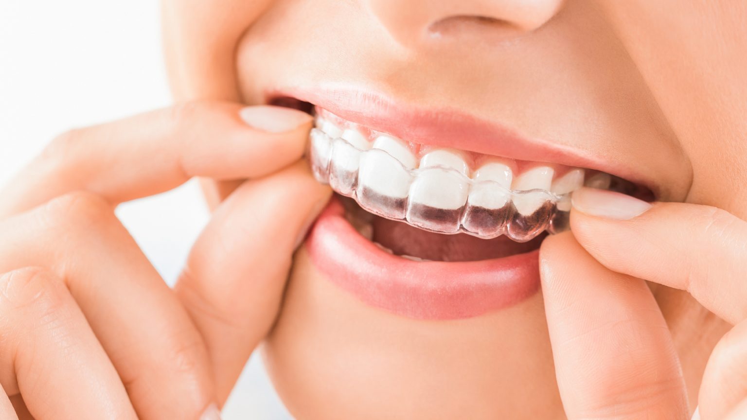 Refaire Ses Dents Les Solutions Possibles Et Leurs Prix